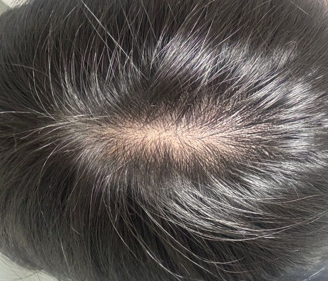 저 20살인데 탈모인가요..ㅠㅠㅠ의 0번 째 이미지