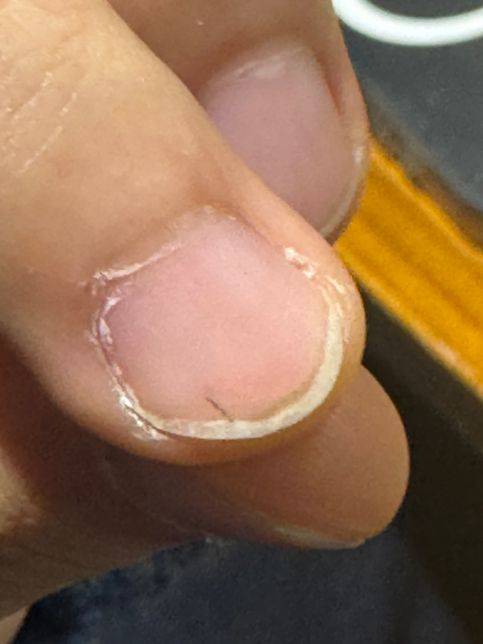 손톱에 머리카락이 끼었는데 빠지지 않아요의 0번 째 이미지