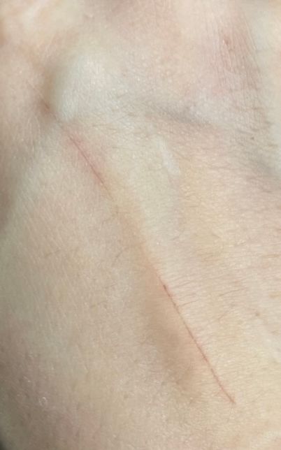 손등에 긁힌 상처 딱지 연고 문의드립니다의 0번 째 이미지