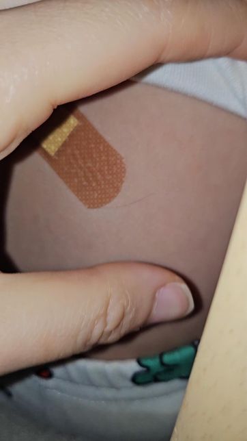 패치붙인부위 피부관련 질문이 있습니다.의 1번 째 이미지