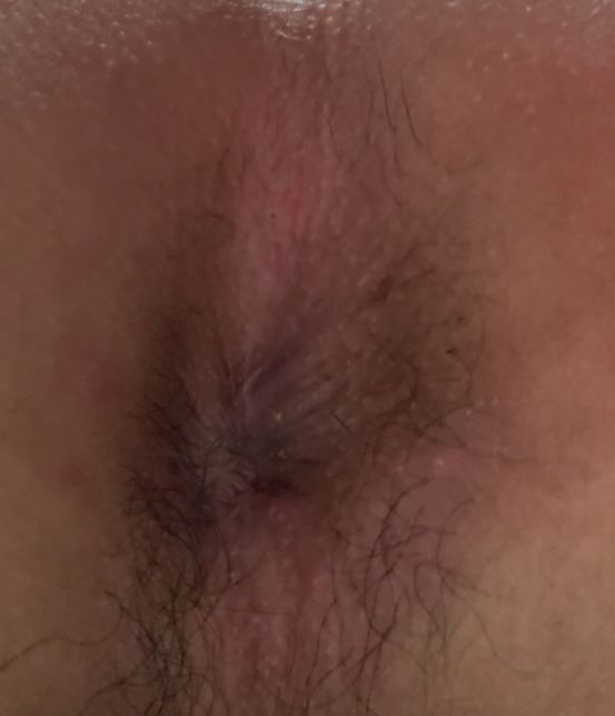 항문소양증? 항문이 간지럽습니다.의 0번 째 이미지