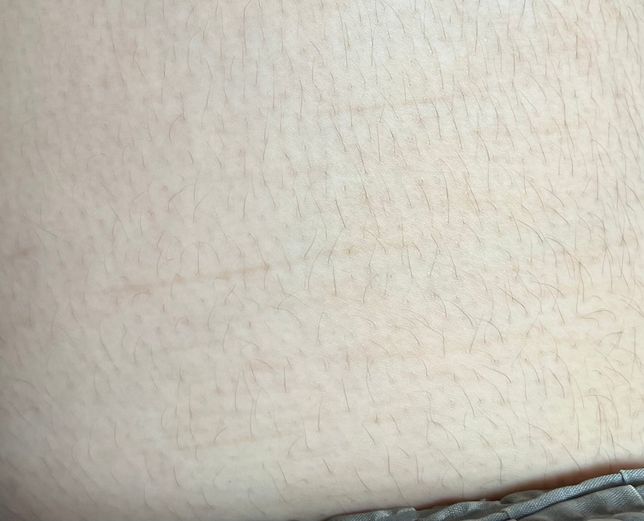 흉터가 자연적으로 사라질 수 있나요?의 1번 째 이미지
