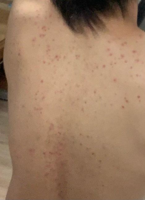 스테로이드제 약 다먹고 피부가 뒤집어졌는데 어떻게 하죠? ㅠ의 0번 째 이미지
