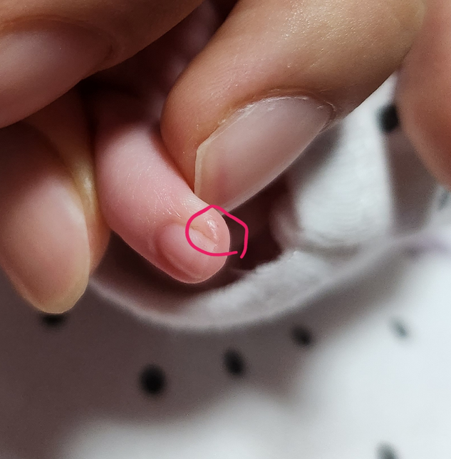 아이 손톱 자르는 중 살을 잘랐는데 괜찮을까요?의 0번 째 이미지