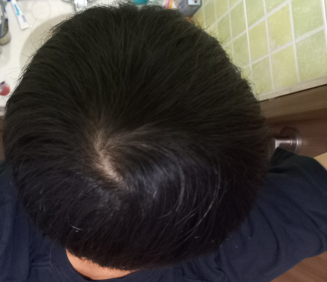 19살 남자 이정도면 정수리 탈모인가요??의 1번 째 이미지