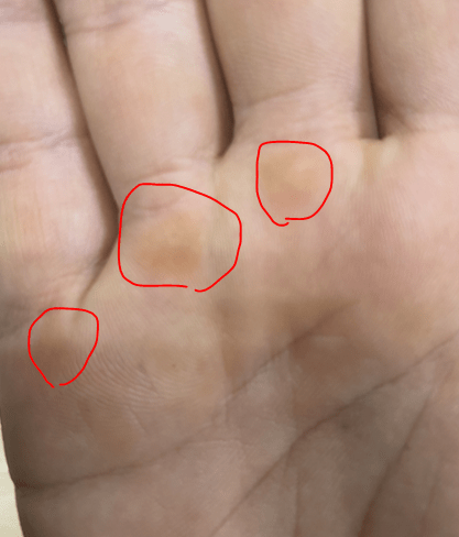 근력 운동중 손바닥에 굳은살? 제거,방지 어떻게 하나요?의 0번 째 이미지