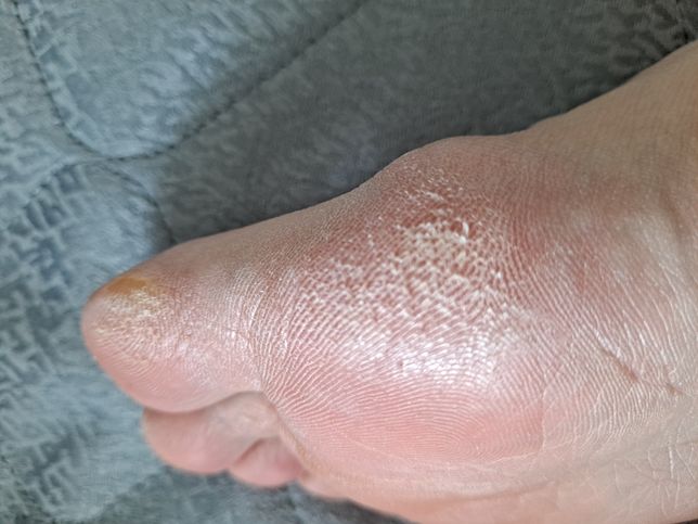 발가락 피부 벗겨짐은 무좀일까요?의 0번 째 이미지