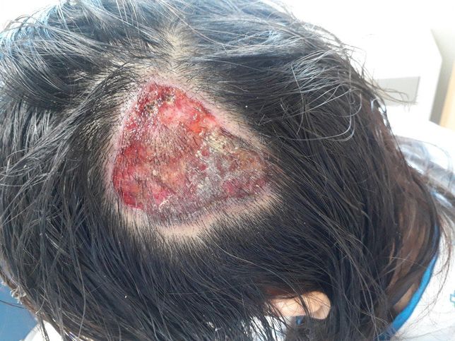 병원의 실수로 인해 대머리가 되었는데, 진정 보상받을 길이 없을까요?의 1번 째 이미지