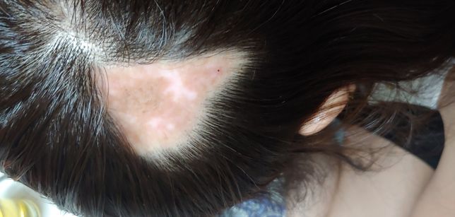 병원의 실수로 인해 대머리가 되었는데, 진정 보상받을 길이 없을까요?의 0번 째 이미지