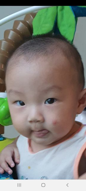 6개월 아기 볼에 여드름 터짐...의 0번 째 이미지