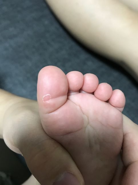 아기발바닥 껍질 까짐이 있어요의 0번 째 이미지