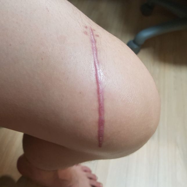 산재 처리를 하였는데 후유장해, 부당해고 관련 궁금한점이 있습니다.[흉터 사진有]의 0번 째 이미지