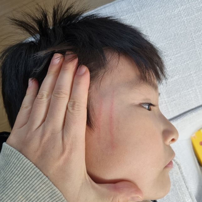 같은 유치원 다른 아이한테 맞아 생긴 상처에 대한 파해보상의 0번 째 이미지