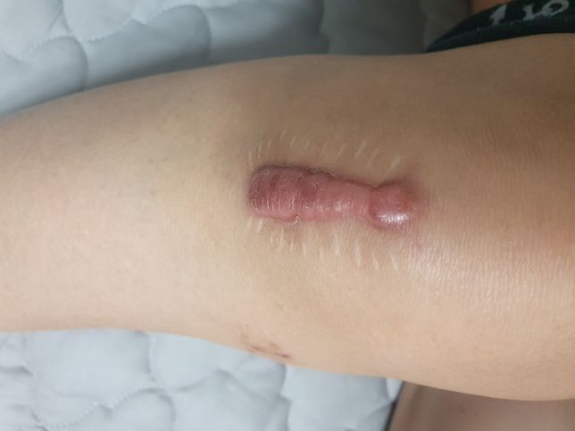 흉터제거수술이나 주사 보험청구의 0번 째 이미지