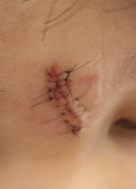 타아파트에서 놀다 놀이터에서 다쳤어요의 0번 째 이미지