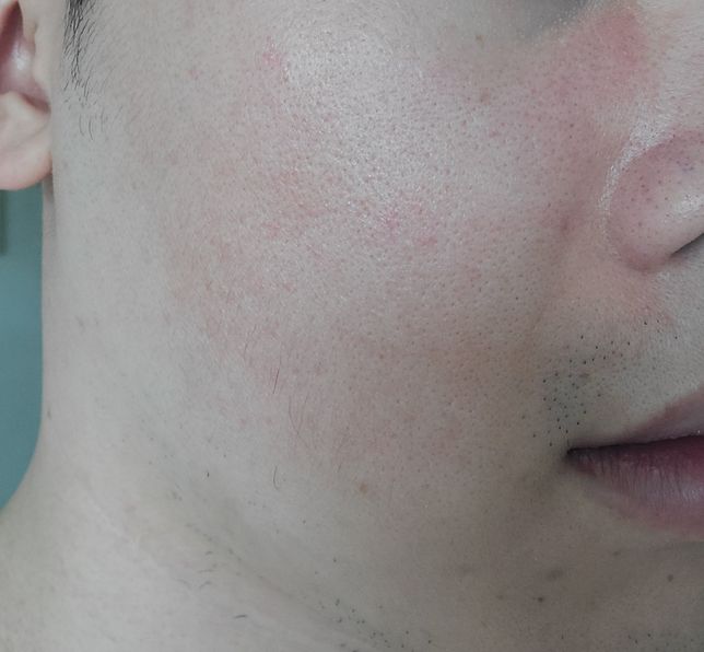 주사피부염 레이저관련 질문이 있습니다!!!의 0번 째 이미지