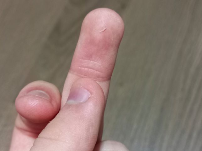 양손 베이고 긁힌 상처 무슨 약 발라줘야 될까요?의 3번 째 이미지