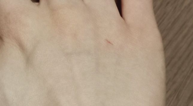 양손 베이고 긁힌 상처 무슨 약 발라줘야 될까요?의 2번 째 이미지