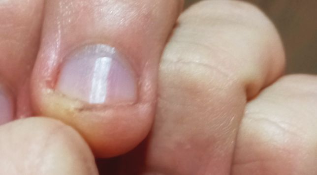 양손 베이고 긁힌 상처 무슨 약 발라줘야 될까요?의 0번 째 이미지