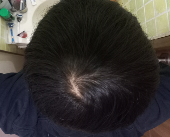 19살 남자 이정도면 정수리 탈모인가요??의 0번 째 이미지