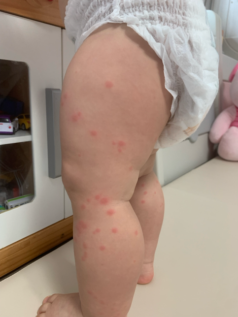 16개월애기 두드러기인지 수두인지 궁굼하네요 ㅠㅠㅠ의 1번 째 이미지