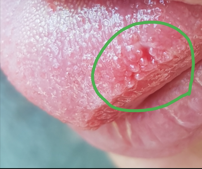 혀 측면 파인 게 한달이 다 되었는데 안낫고 있어서요의 0번 째 이미지