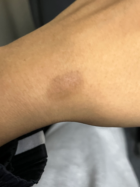 화상으로 인해 흉터가 생겼는데 습윤드레싱 부착하면 흉터 없애는데 도움이 될까요?의 0번 째 이미지