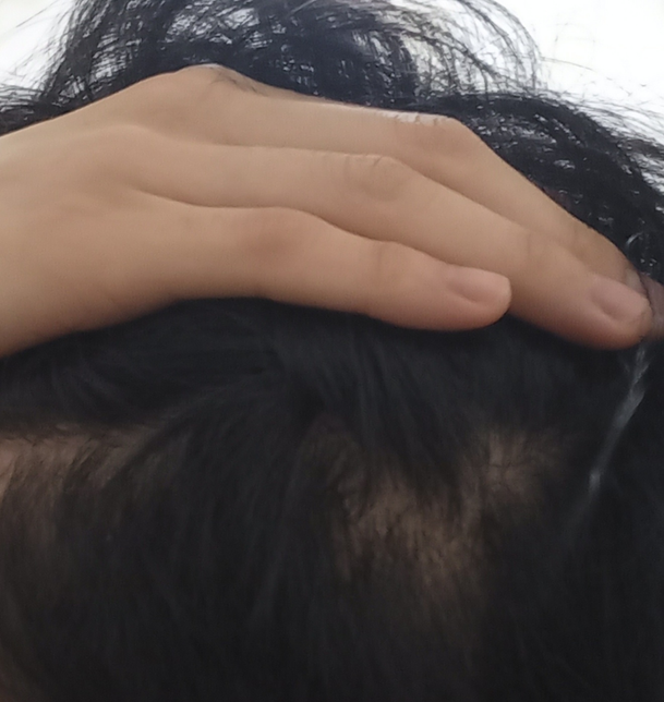 19살 옆머리 탈모 인가요??의 0번 째 이미지