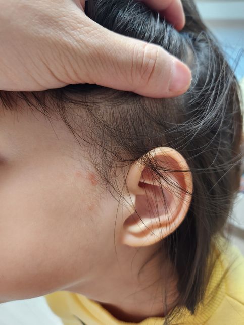 아이 왼쪽 뺨에 생긴 피부 질환이 계속 재발 되는 것 같은데, 연고 추천 부탁드립니다.의 1번 째 이미지