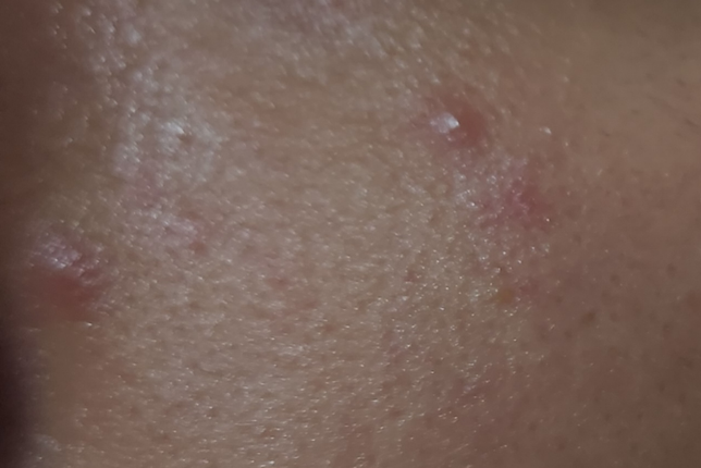 얼굴에 두드러기가 자주 나는데 스테로이드 연고 말고...의 0번 째 이미지