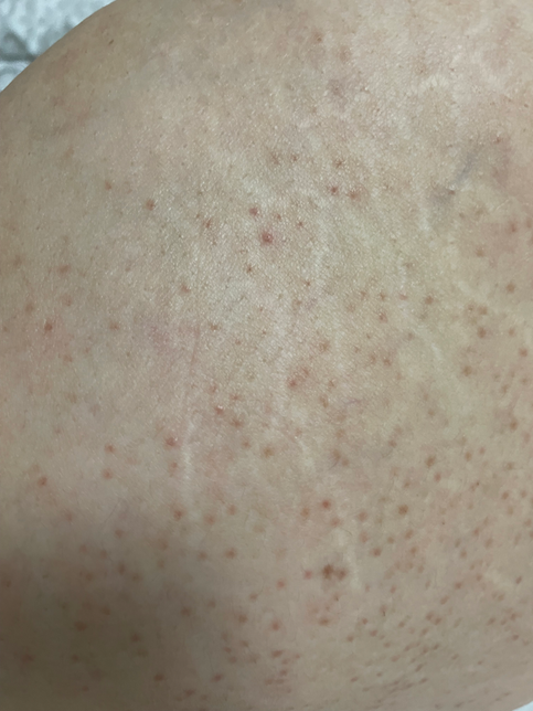 엉덩이 피부때문에 고민이에요 해결할 방법이 있으려나의 0번 째 이미지