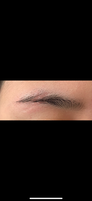 2년 전 모텔 화장실에서 넘어져 변기에 눈썹을 찧었는데요의 0번 째 이미지