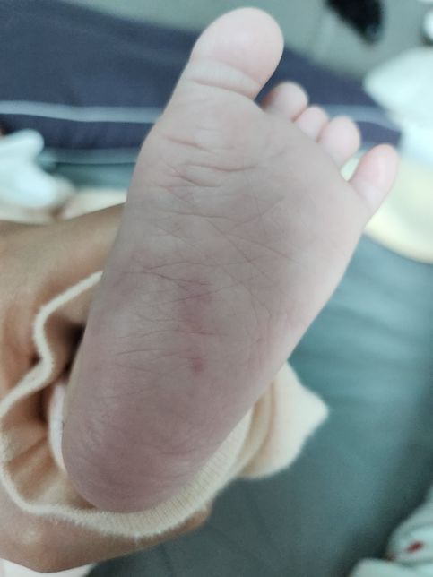 갑자기생겼어요 발바닥 붉은 점 뭘까요 ?의 1번 째 이미지