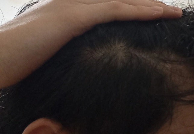 19살 옆머리 탈모 인가요??의 1번 째 이미지