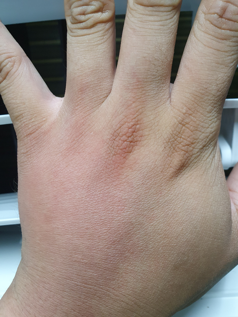 벌에 쏘인 자리가 부어요 그리고 막 땡기고 애려요의 0번 째 이미지