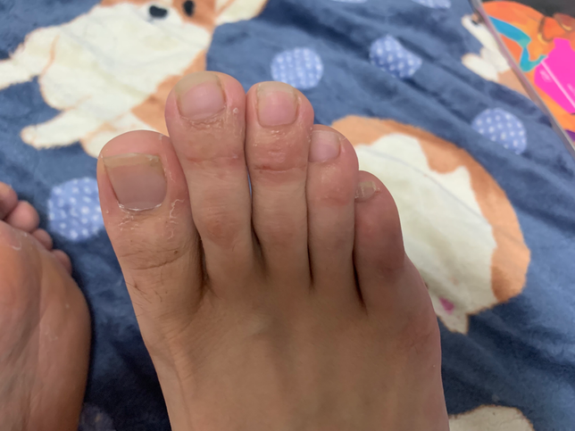 습진인지 무좀인지 알수있을까요?의 2번 째 이미지