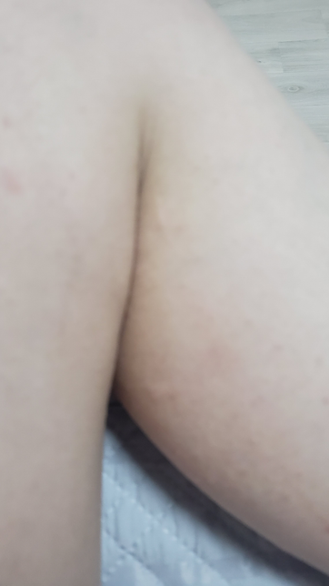 피부에 모기물린자국처럼 이상한게났어요 모기는아니에요의 2번 째 이미지