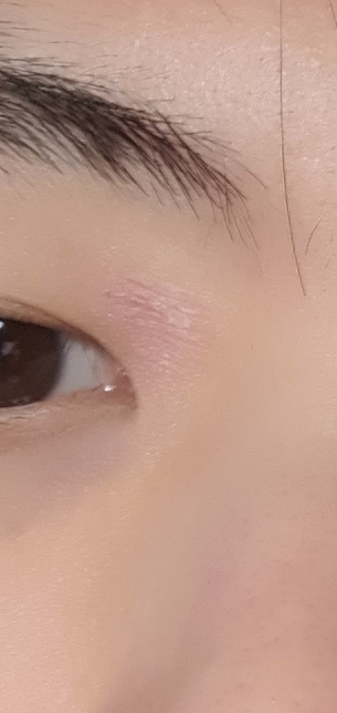 눈 주위가 막 건조하고 각질일어남의 0번 째 이미지