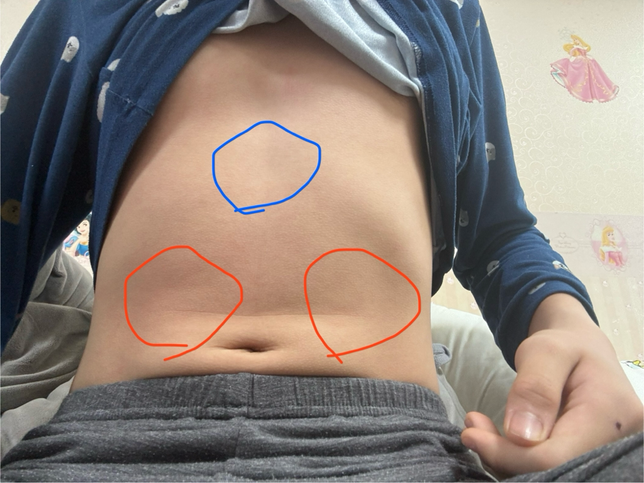 대장에 암이 있을수가 있을까요?의 0번 째 이미지