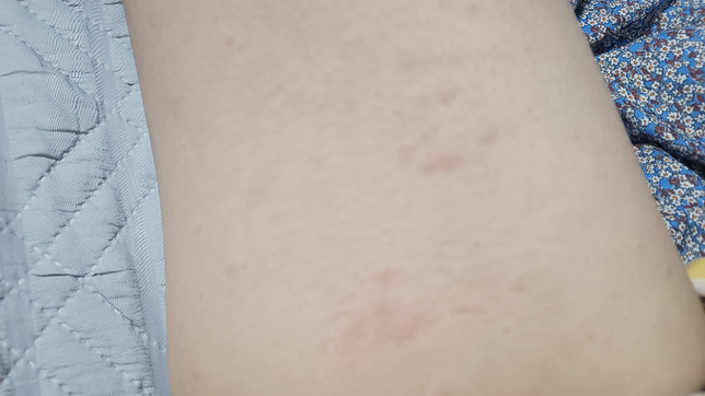 피부에 모기물린자국처럼 이상한게났어요 모기는아니에요의 0번 째 이미지