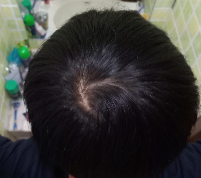 19살 남자 이정도면 정수리 탈모인가요??의 2번 째 이미지