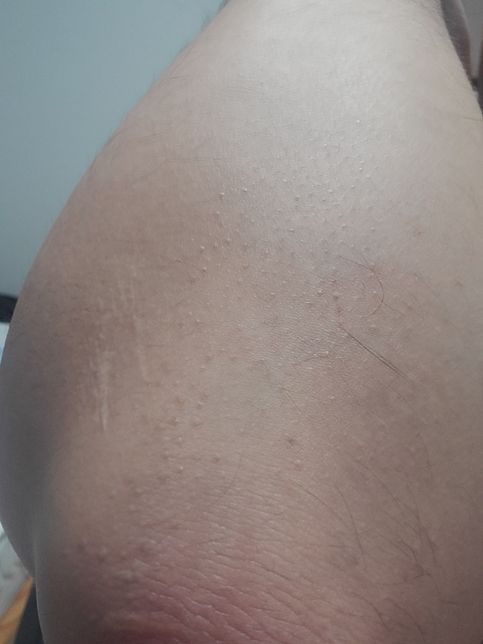 아드반탄이랑 신풍겐타마이신황산염크림 오래 써도 괜찮나요?의 0번 째 이미지