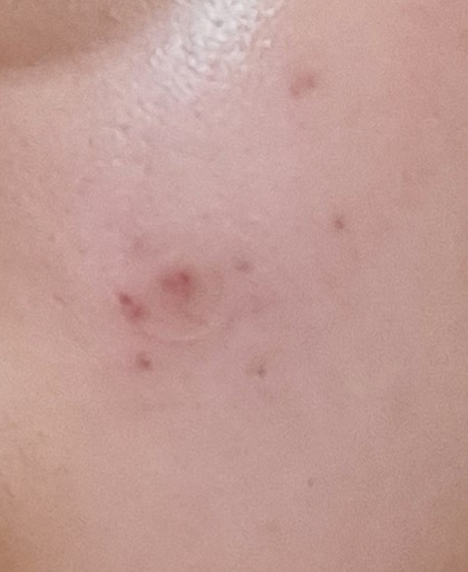 붉은 여드름 색소침착은 어떻게 없앨 수 있을까요?의 0번 째 이미지