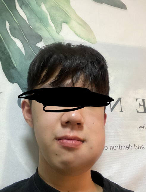 2년전 충치 때문에 치과갔다가 사랑니 발치를 요구받고 의료사고로 어금니를 잃었는데 소송 가능할까요?의 0번 째 이미지