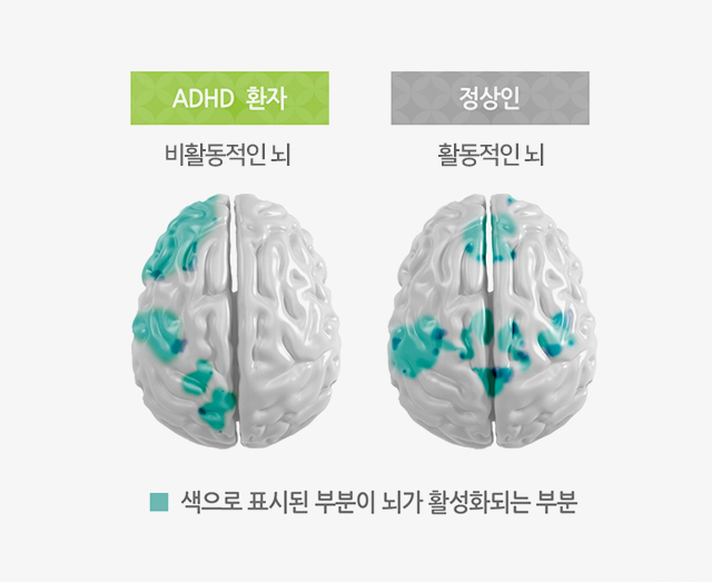주의력이 결핍되면 과잉행동이 늘어나는 이유의 1번 째 이미지