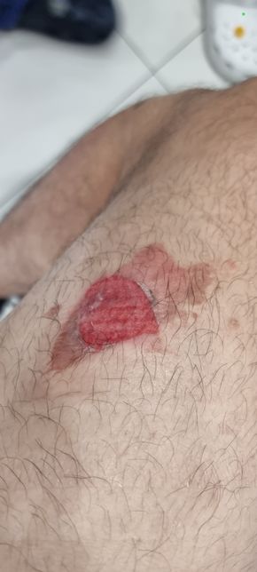 식당에서 화상을 입었을땐 어떻게 하는게 좋을까요?의 0번 째 이미지