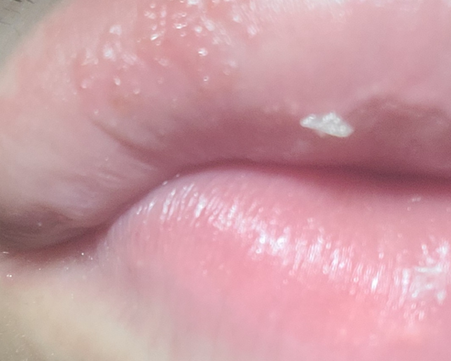 입술에 물집? 포진?같은게 생겼는데 어떤연고 발라야하나요?의 1번 째 이미지