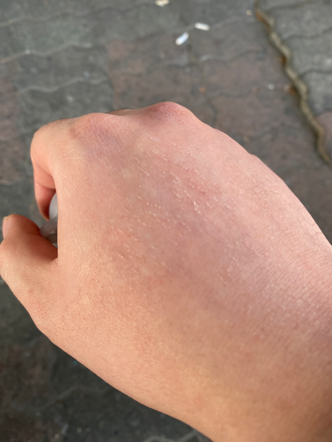 손등 피부가 이렇게되는데 왜이런가요?의 0번 째 이미지