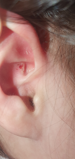 아기가 귀속에 무언가를 넣어서 긁힌건 같아요. 어떤약 바를수 있나요?의 0번 째 이미지