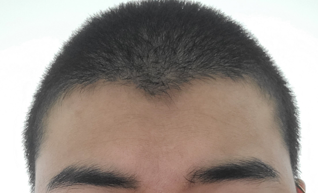 이거 M자탈모 초기증상 인가요?의 0번 째 이미지